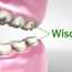 Wisdom Teeth Symptoms: When They Come & Why Needs To Remove?
