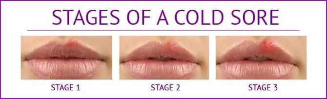 Everything you should know about the Cold sore