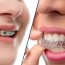 How Can I Find Best Alternatives To Braces?