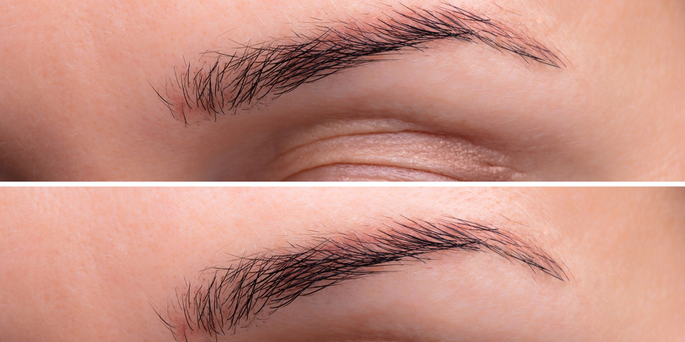 Everything You Need To Know About Brow Lift Treatment