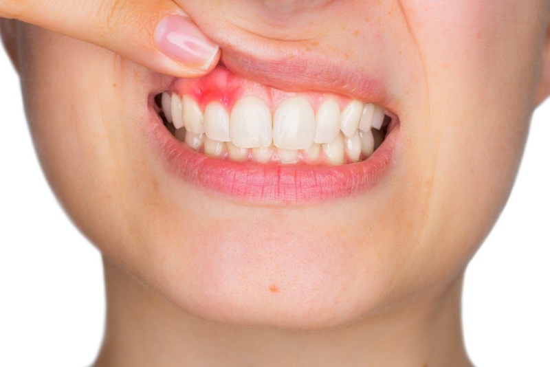 reverse periodontal disease