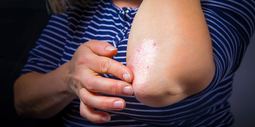Managing Psoriasis: 5 Treatments That Can Help Reduce The Symptoms