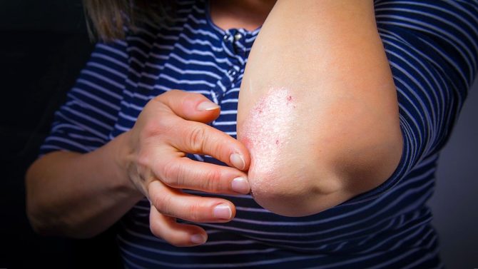 Managing Psoriasis: 5 Treatments That Can Help Reduce The Symptoms